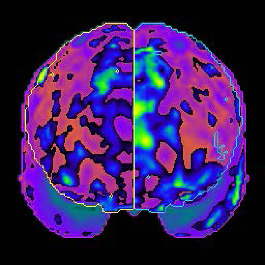 New evidence of ‘chemo brain’ proves cognitive damage from