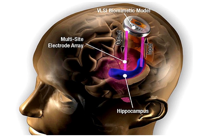 brain-implant-hippocampus-usc.jpg