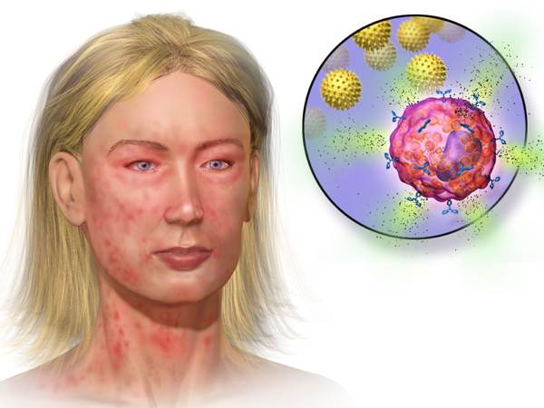 Illustration depicting mast cell activation and anaphylaxis: Blausen.com staff. Blausen gallery 2014.  Wikiversity Journal of Medicine. DOI:10.15347/wjm/2014.010. ISSN 20018762. - Own work